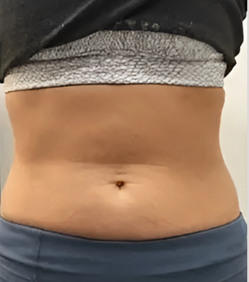 Emily Chen after treatment