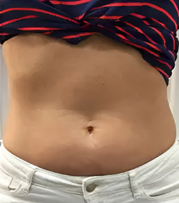 Emily Chen before treatment